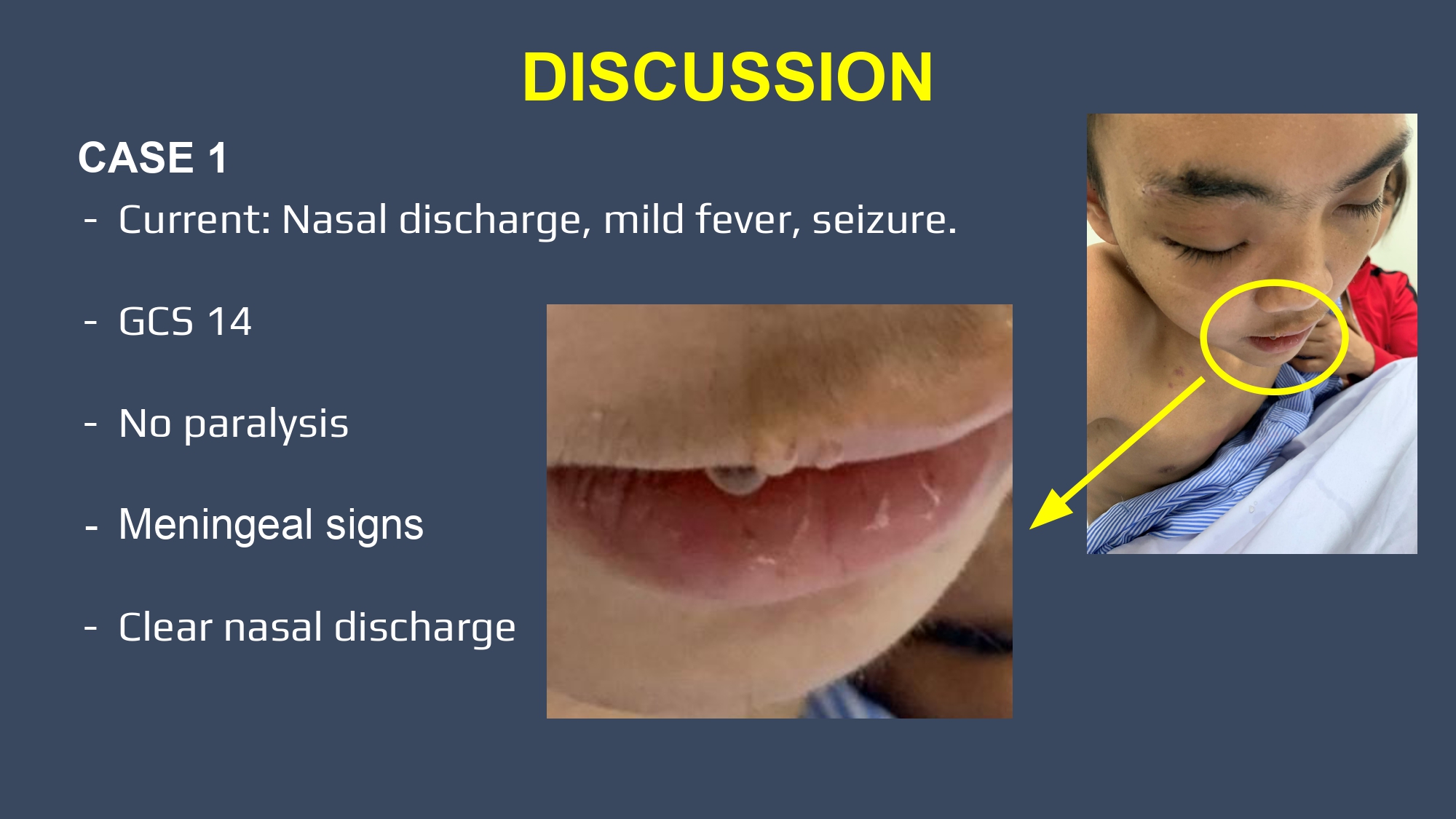 CSF leakge - Nguyen Thanh Bac.pptx_page-0003