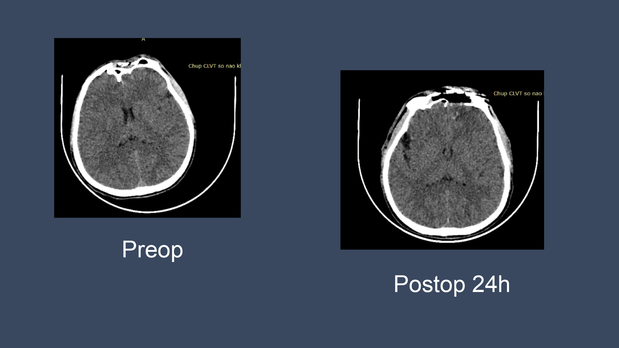 CSF leakge - Nguyen Thanh Bac.pptx_page-0008