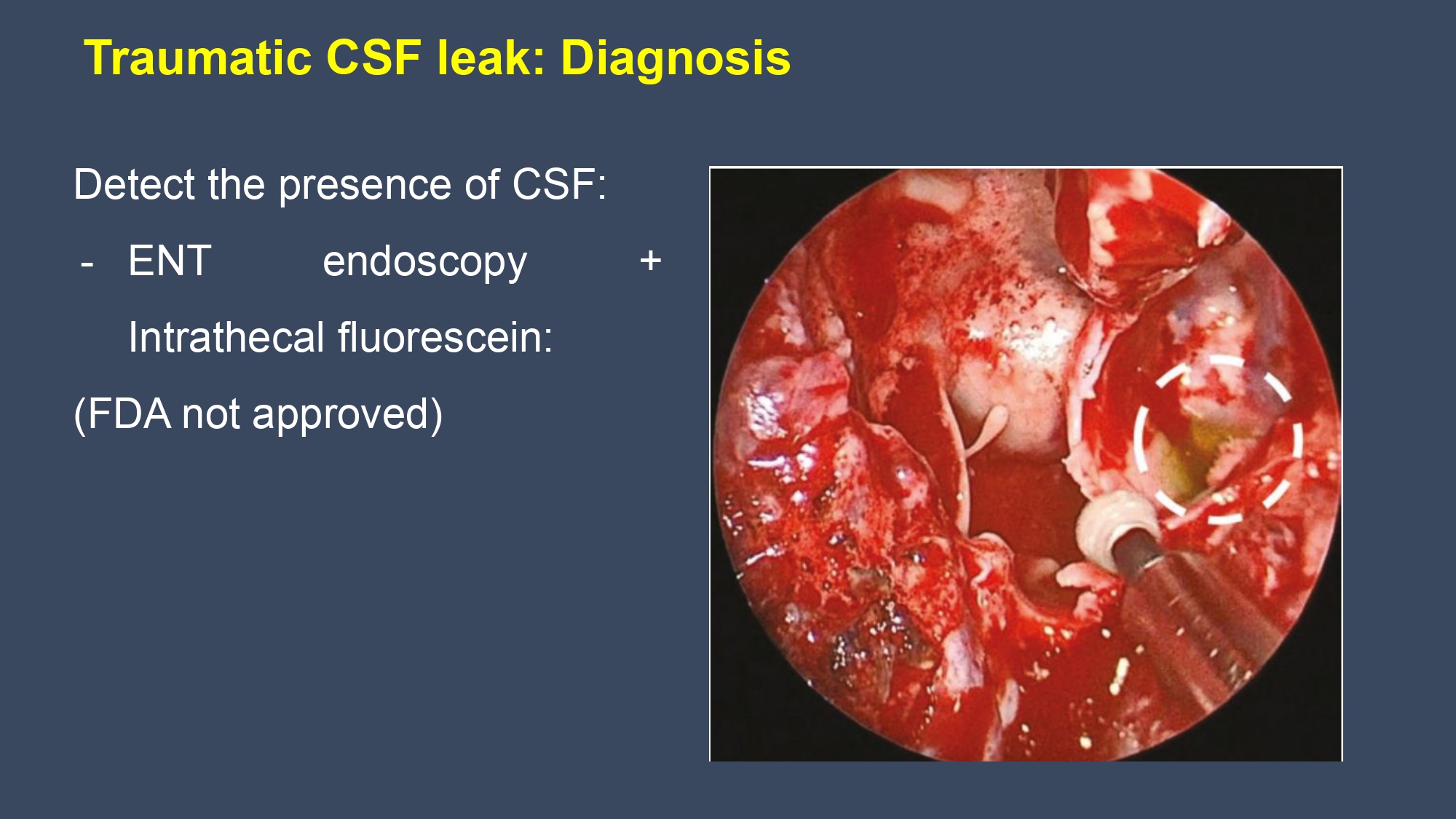 CSF leakge - Nguyen Thanh Bac.pptx_page-0014