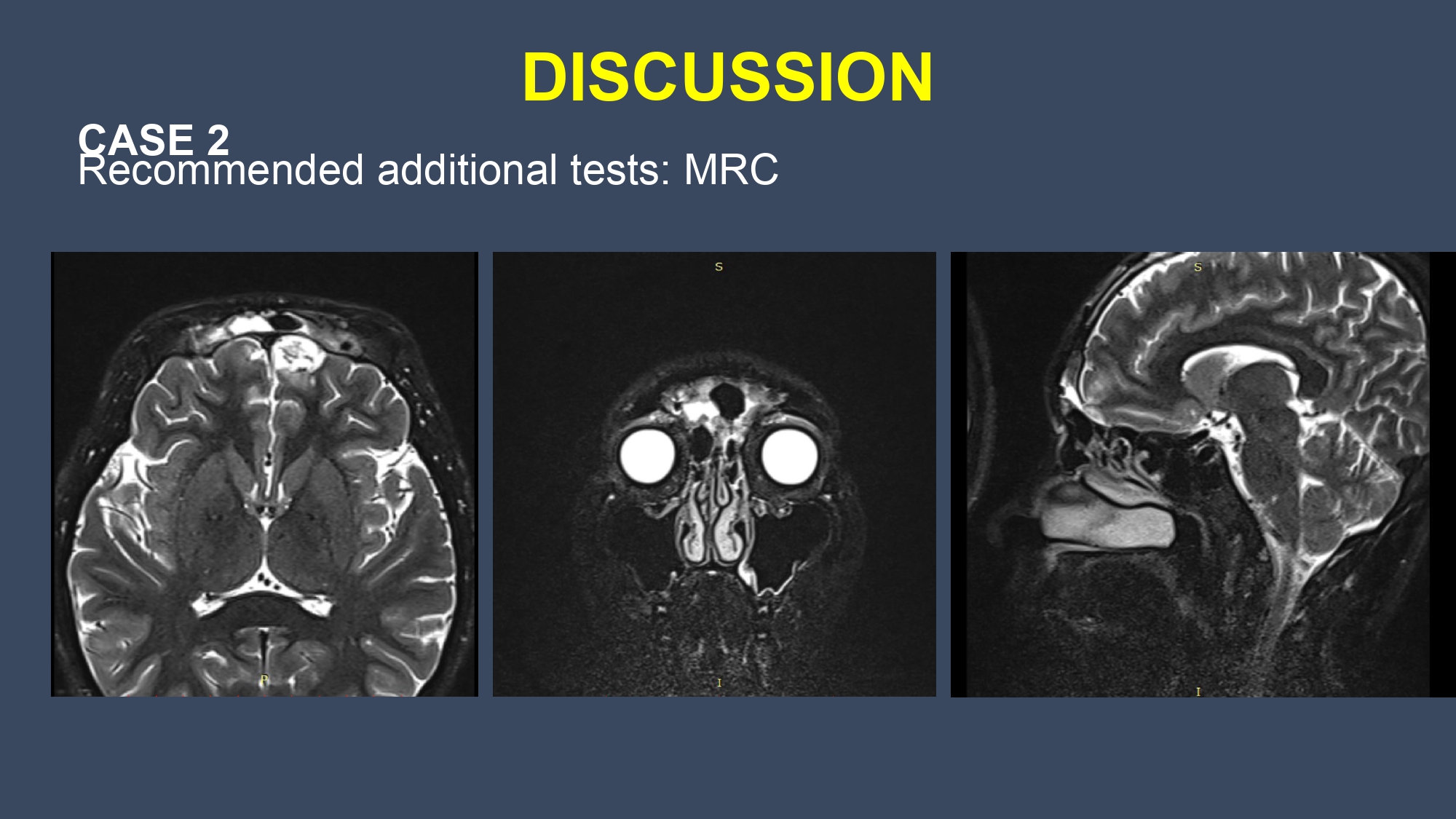 CSF leakge - Nguyen Thanh Bac.pptx_page-0023