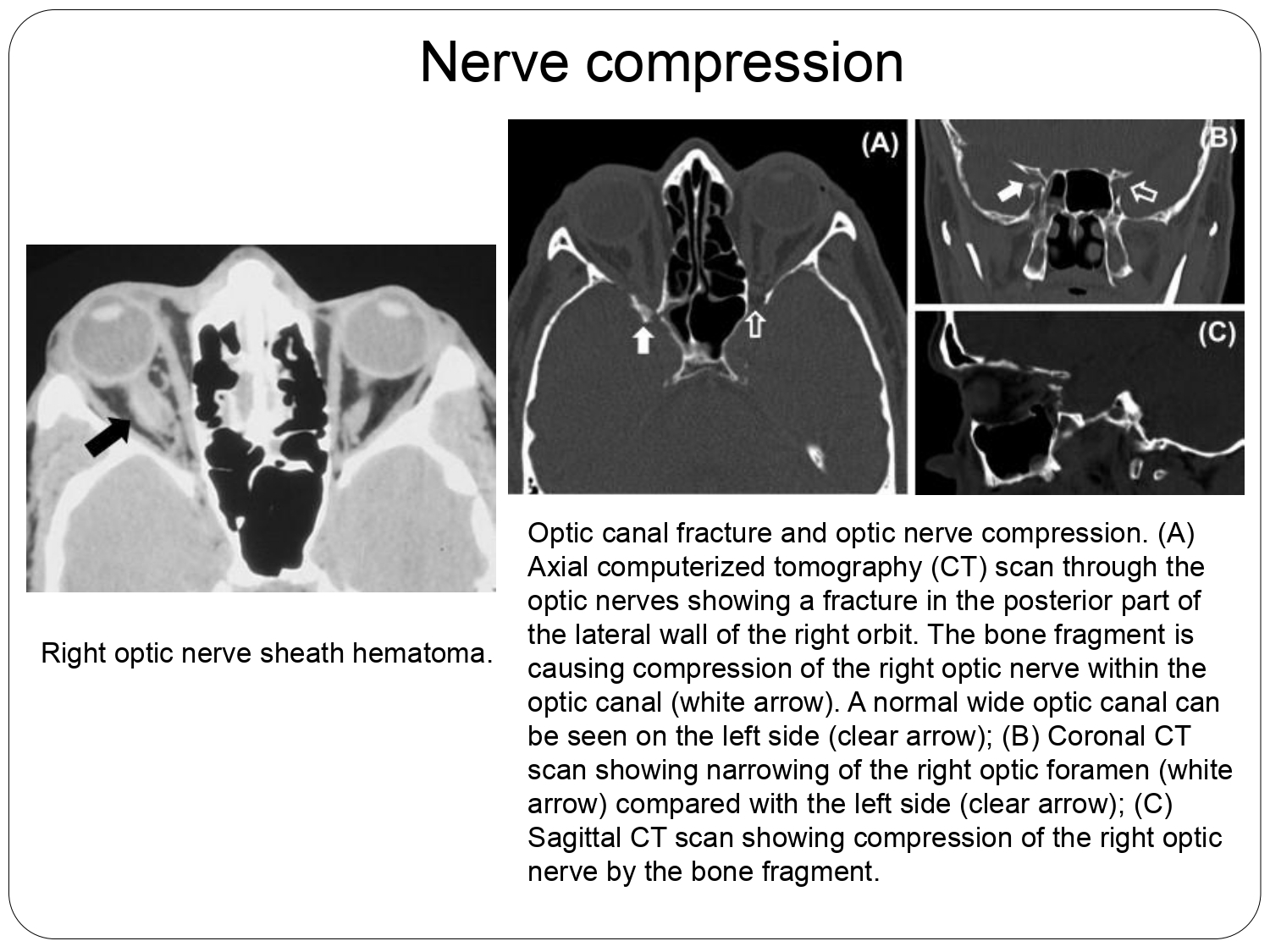 SBT Considerations and Review of Management Techniques and Surgical Approaches_page-0010