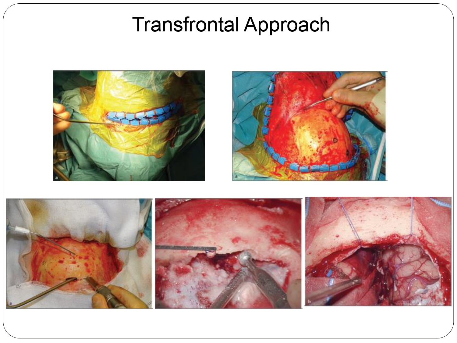 SBT Considerations and Review of Management Techniques and Surgical Approaches_page-0015