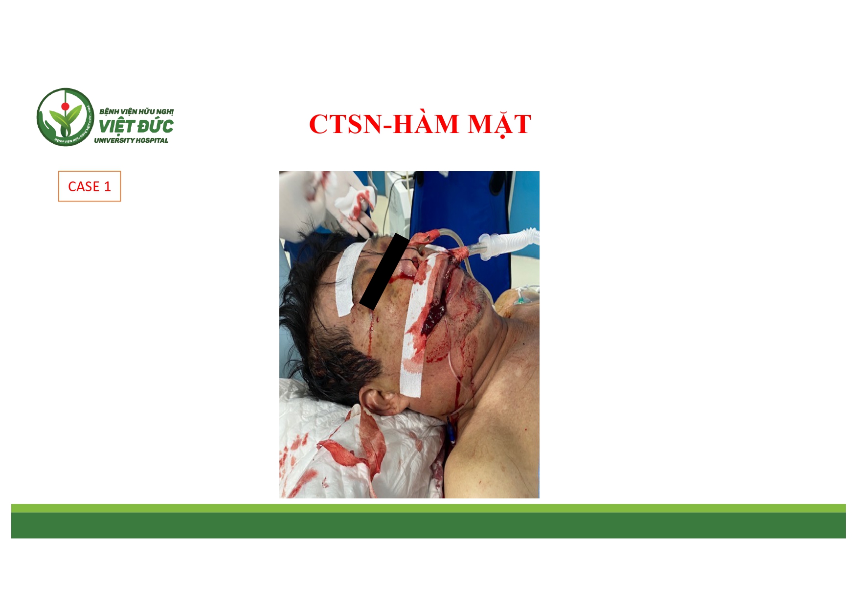 CASE LA╠éM SA╠ÇNG CHA╠é╠üN THU╠øO╠øNG SO╠ú NA╠âO VA╠Ç HA╠ÇM MA╠ú╠éT 4.11.2025 (1)_page-0002