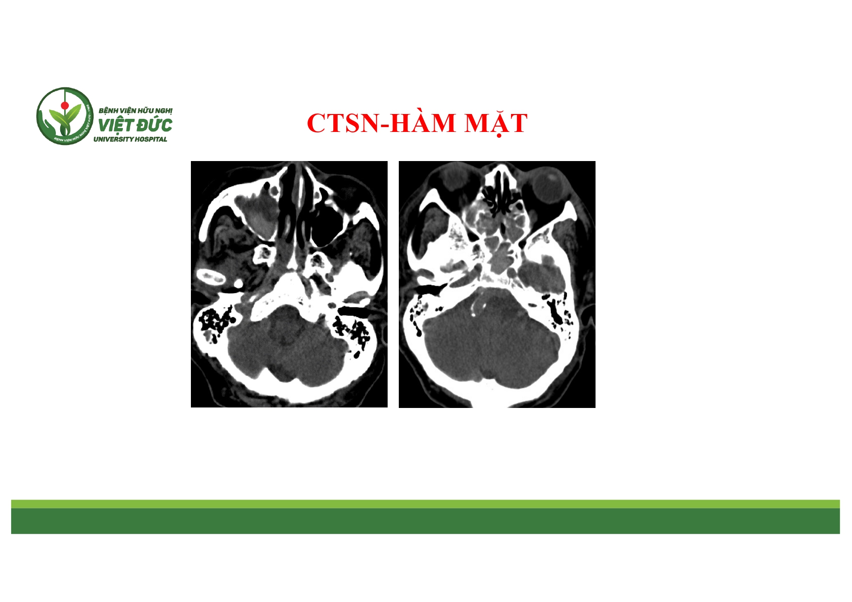 CASE LA╠éM SA╠ÇNG CHA╠é╠üN THU╠øO╠øNG SO╠ú NA╠âO VA╠Ç HA╠ÇM MA╠ú╠éT 4.11.2025 (1)_page-0003