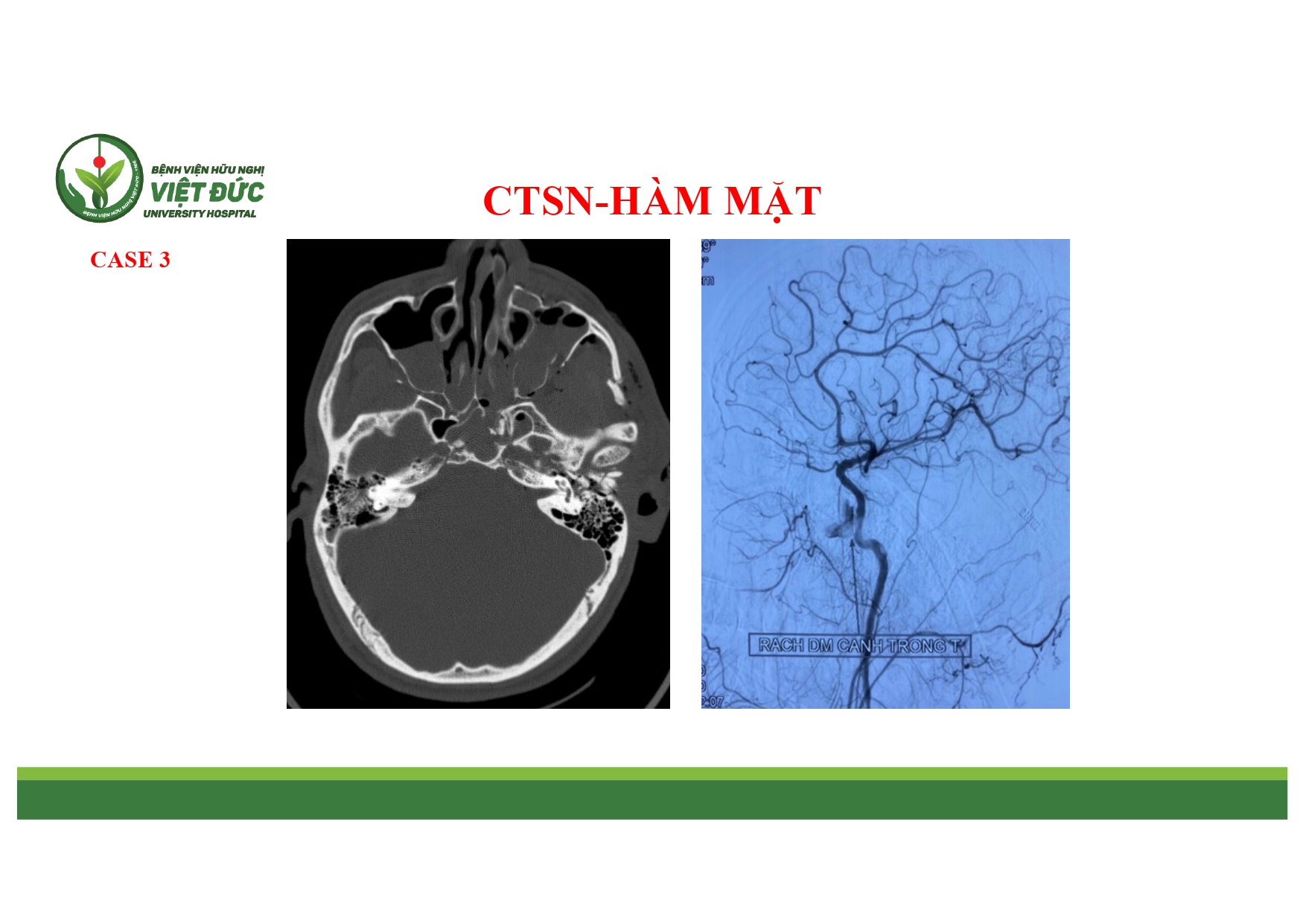 CASE LA╠éM SA╠ÇNG CHA╠é╠üN THU╠øO╠øNG SO╠ú NA╠âO VA╠Ç HA╠ÇM MA╠ú╠éT 4.11.2025 (1)_page-0007