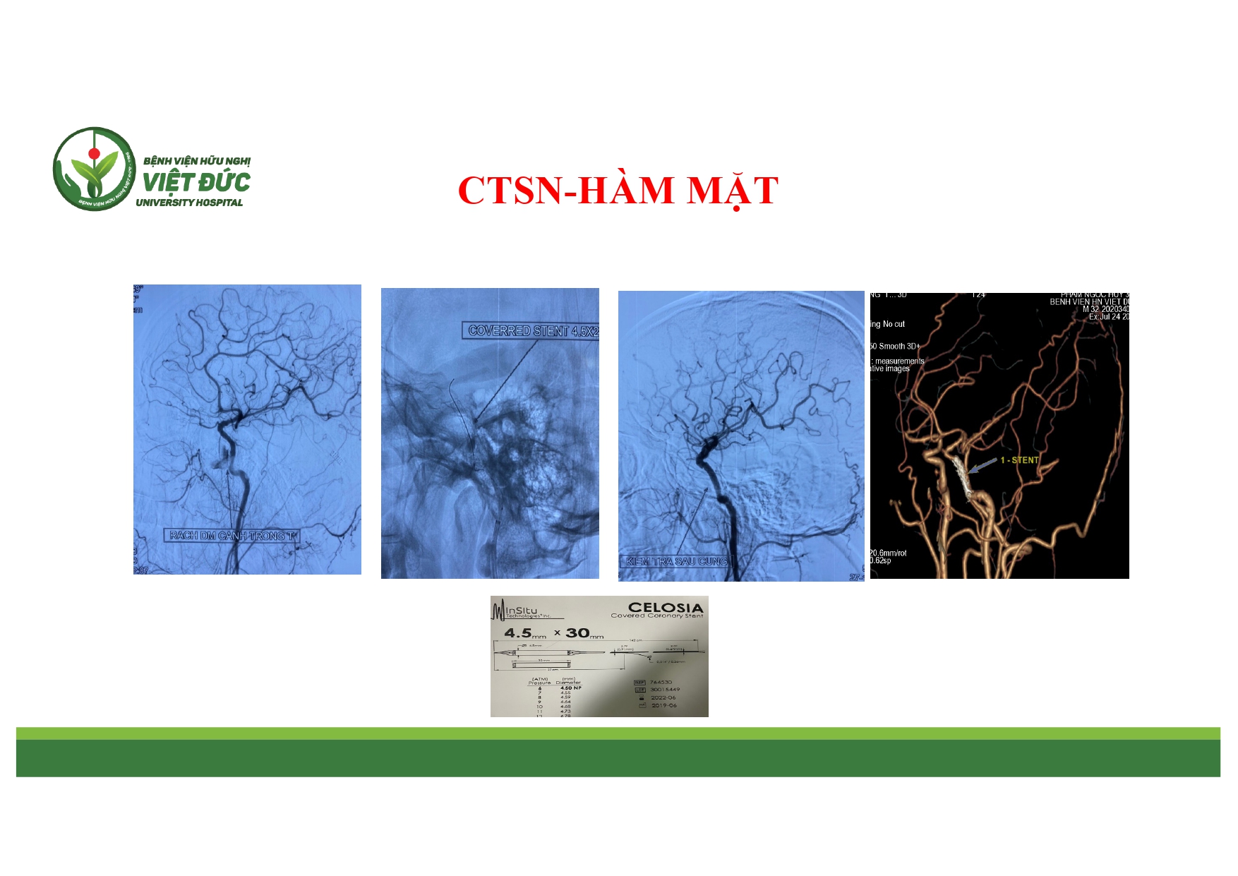 CASE LA╠éM SA╠ÇNG CHA╠é╠üN THU╠øO╠øNG SO╠ú NA╠âO VA╠Ç HA╠ÇM MA╠ú╠éT 4.11.2025 (1)_page-0008