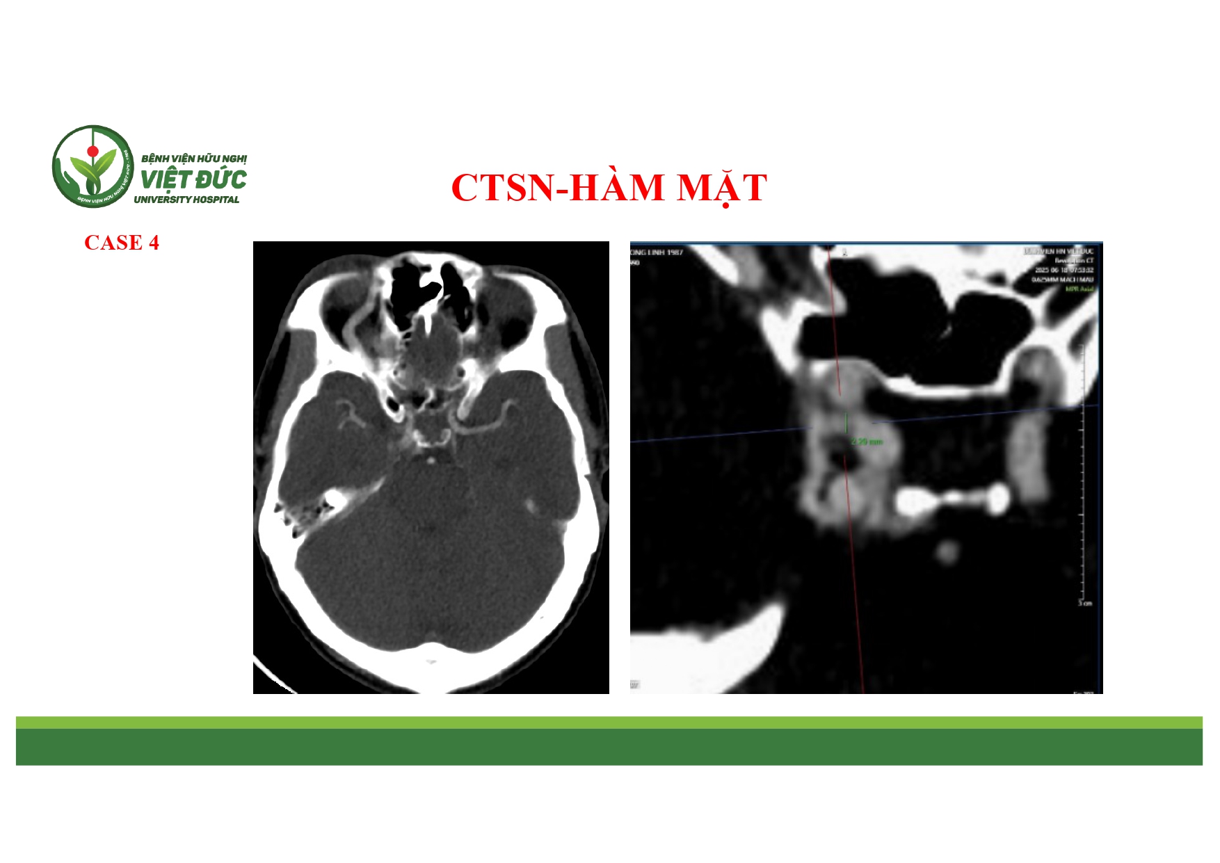 CASE LA╠éM SA╠ÇNG CHA╠é╠üN THU╠øO╠øNG SO╠ú NA╠âO VA╠Ç HA╠ÇM MA╠ú╠éT 4.11.2025 (1)_page-0010