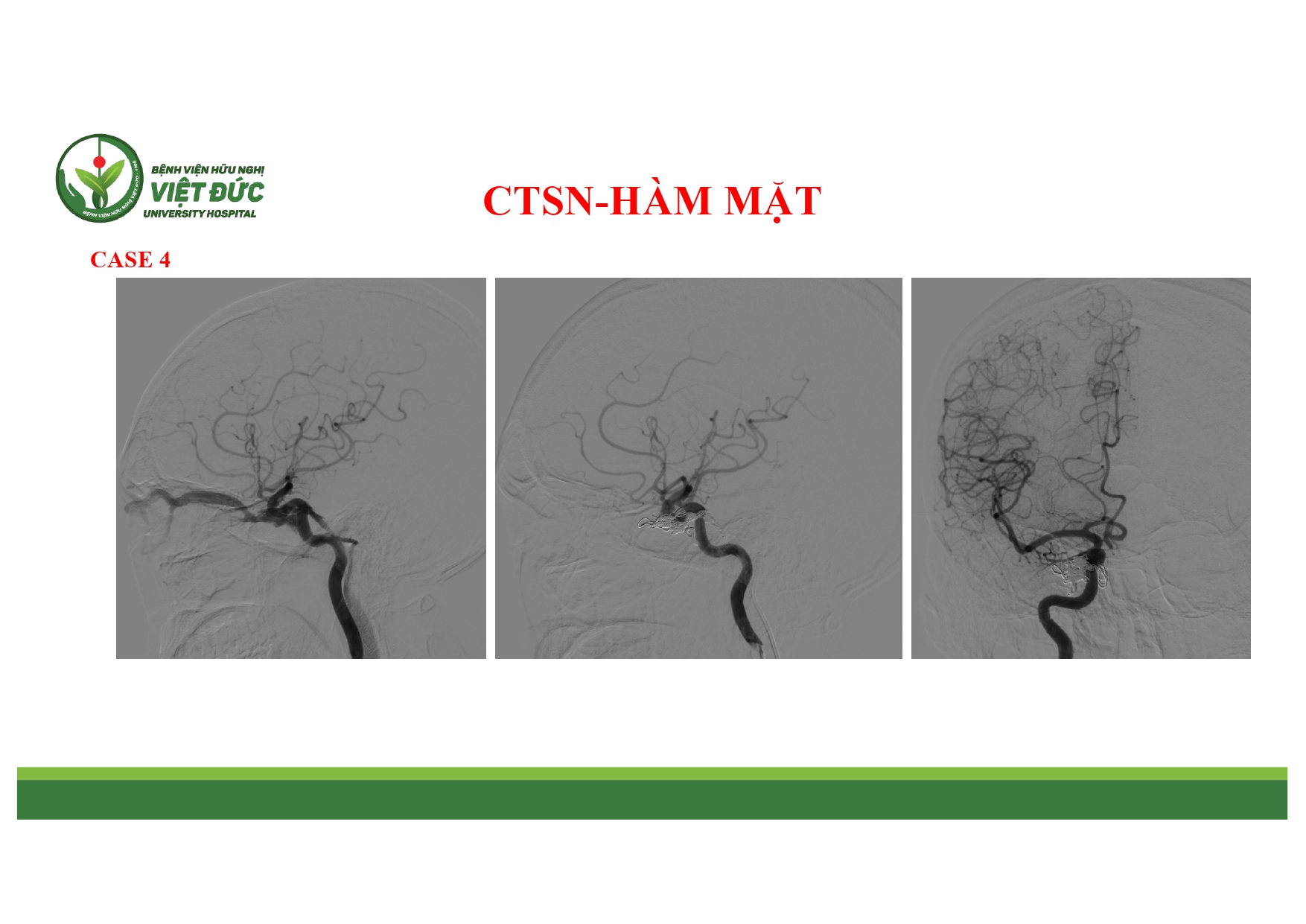 CASE LA╠éM SA╠ÇNG CHA╠é╠üN THU╠øO╠øNG SO╠ú NA╠âO VA╠Ç HA╠ÇM MA╠ú╠éT 4.11.2025 (1)_page-0011