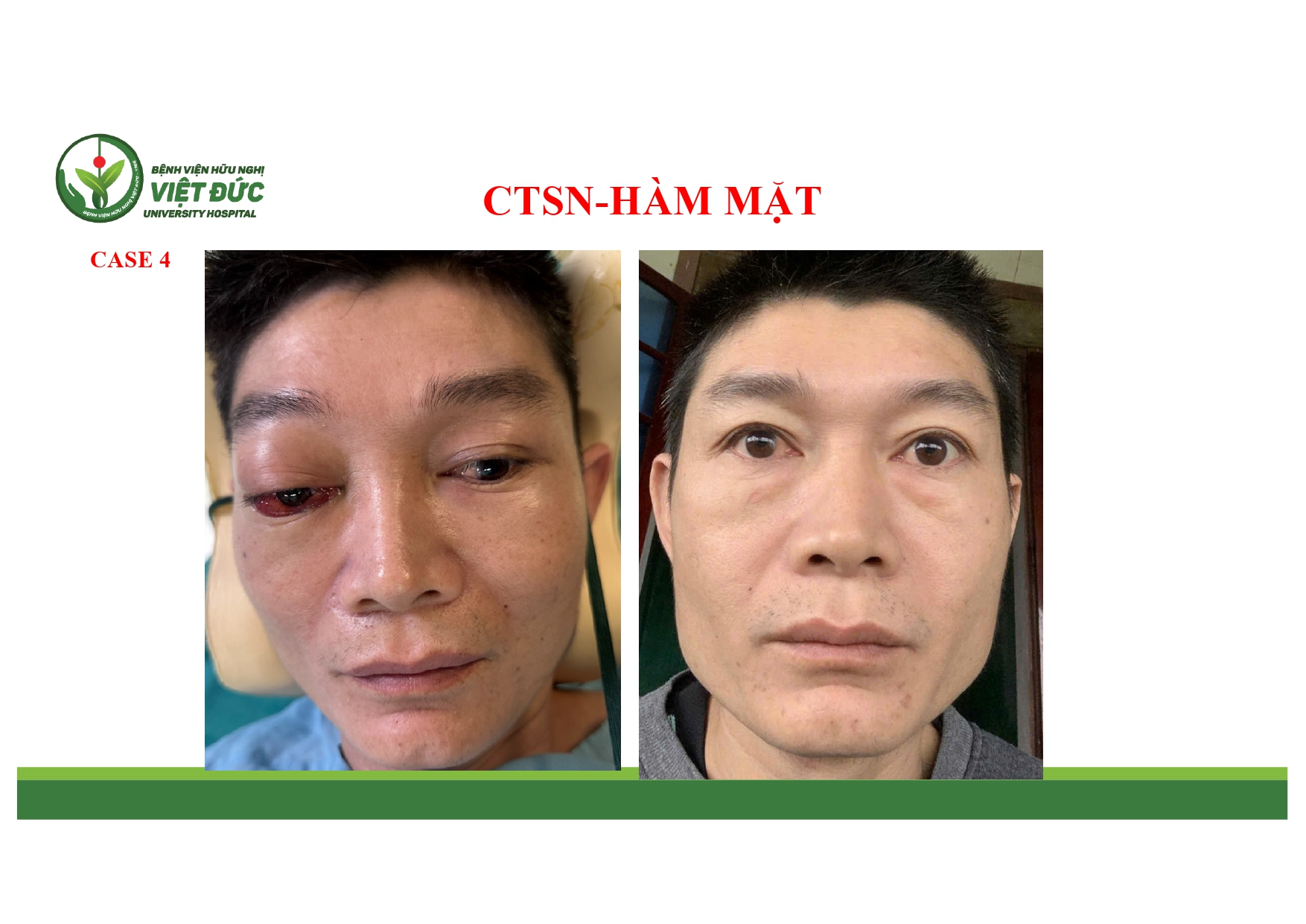 CASE LA╠éM SA╠ÇNG CHA╠é╠üN THU╠øO╠øNG SO╠ú NA╠âO VA╠Ç HA╠ÇM MA╠ú╠éT 4.11.2025 (1)_page-0012